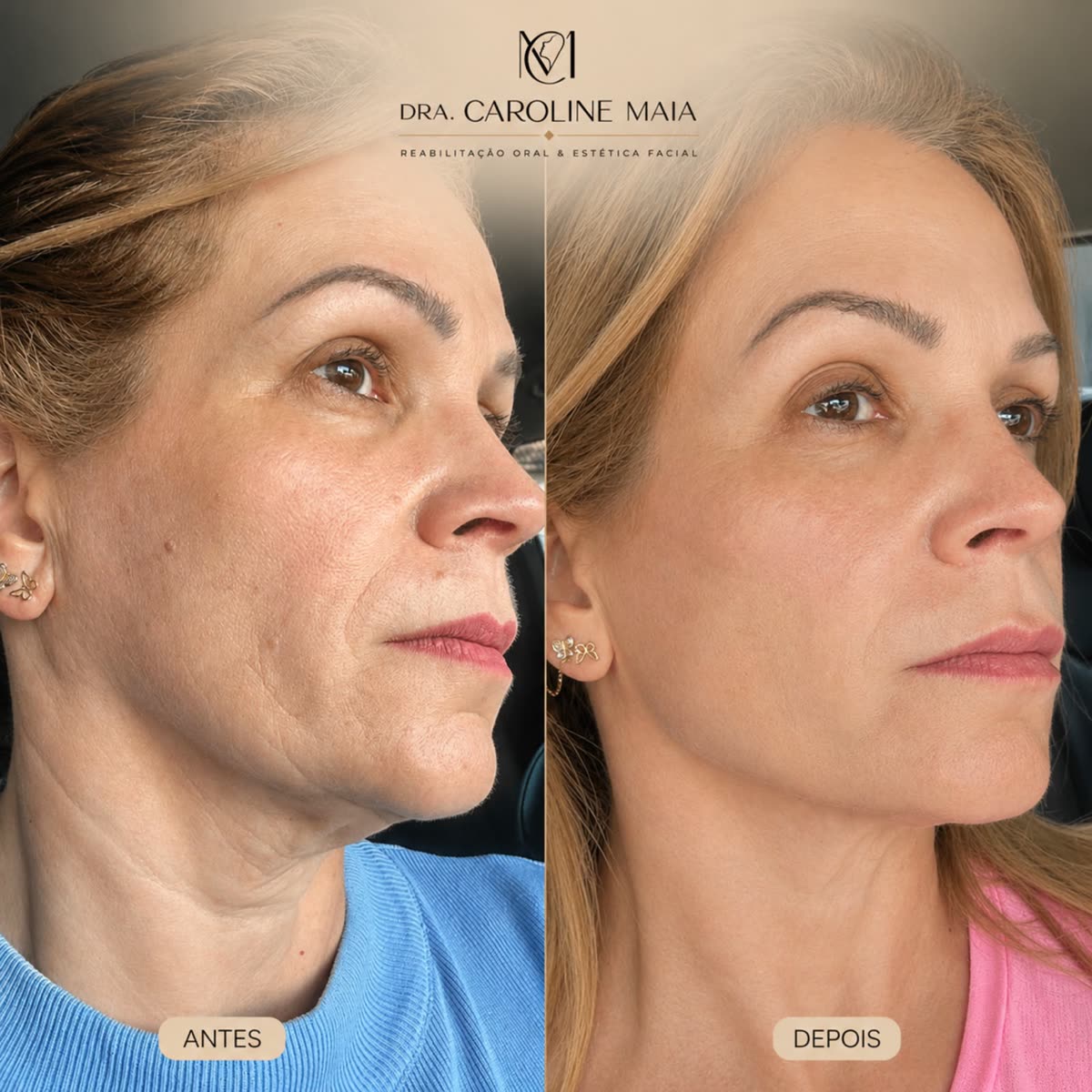 Antes e depois — Definição de contorno · Dra. Caroline Maia