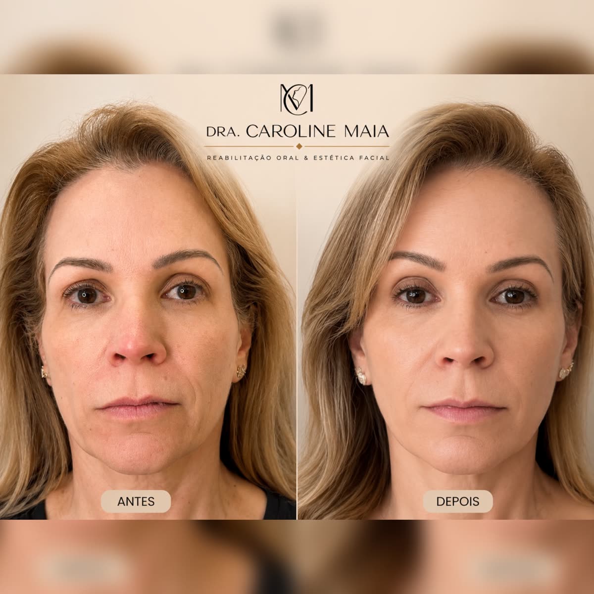 Antes e depois — Rejuvenescimento facial · Dra. Caroline Maia