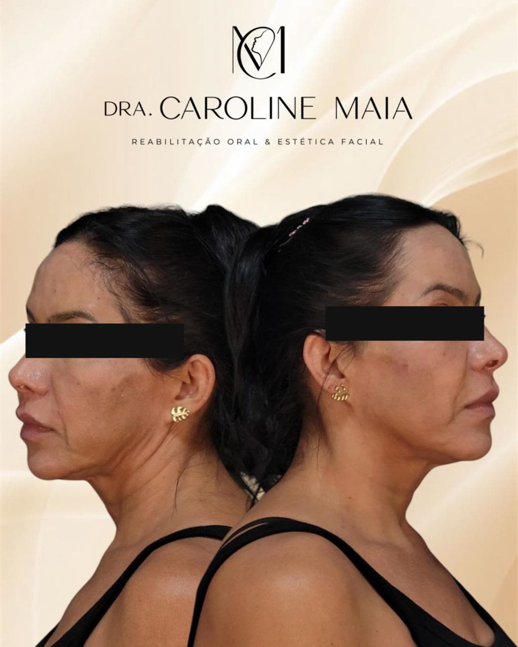 Antes e depois — Perfil e contorno · Dra. Caroline Maia