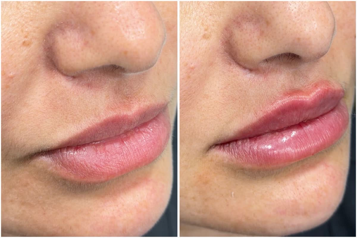 Antes e depois — Definição do contorno labial · Dra. Caroline Maia