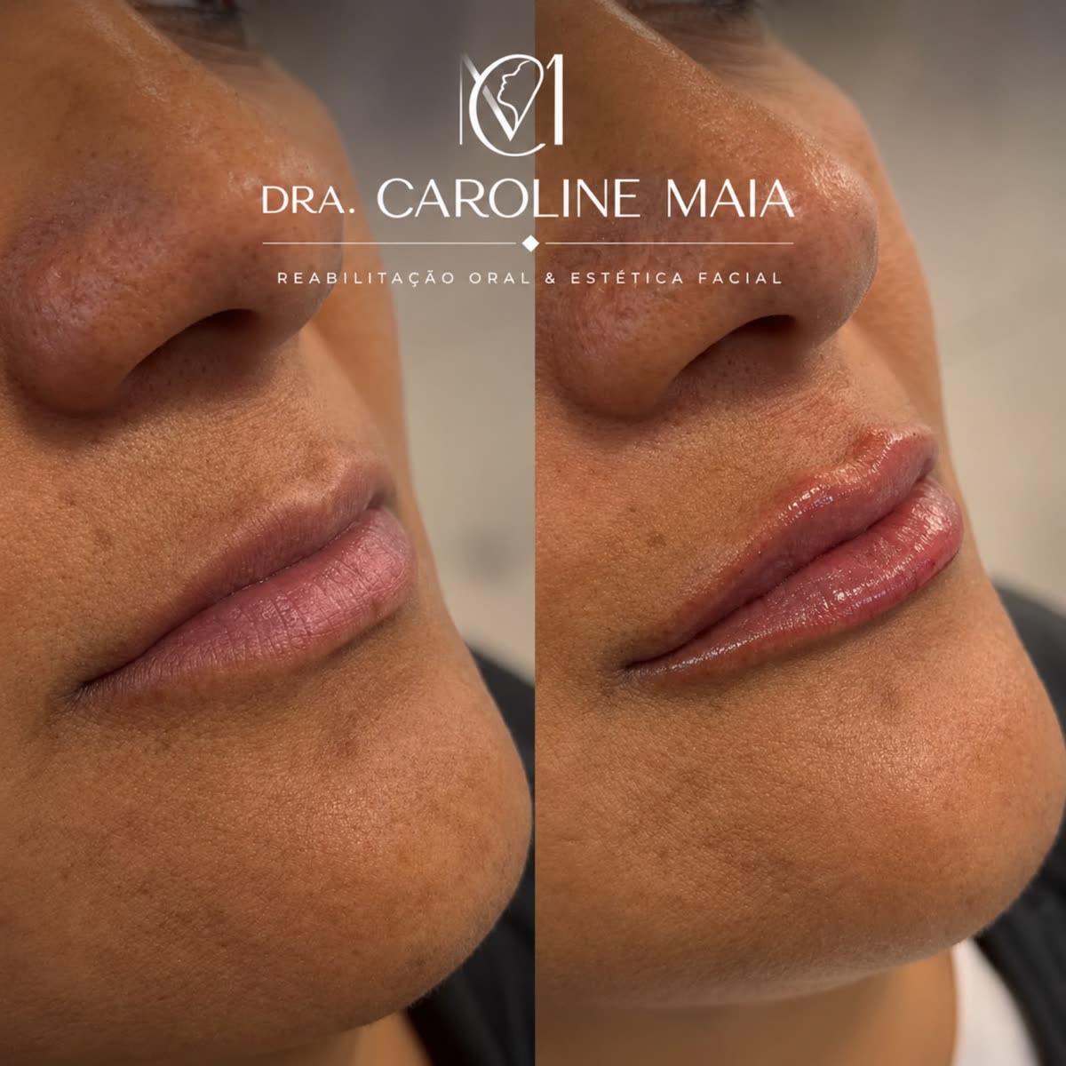 Antes e depois — Volume e hidratação · Dra. Caroline Maia